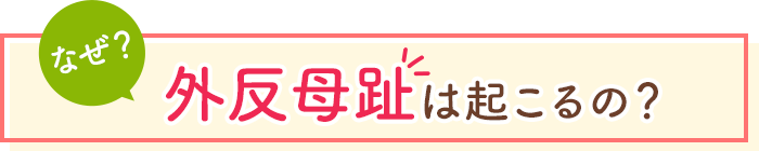 なぜ外反母趾は起こるの？