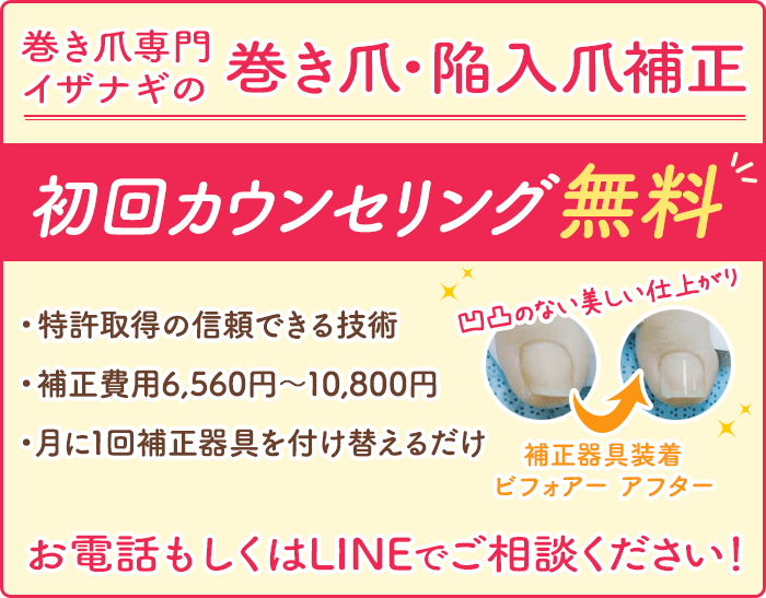 巻き爪専門イザナギの巻き爪・陥入爪補正 ・特許取得の信頼できる技術 ・補正費用6,560円〜10,800円 ・月に1回補正器具を付け替えるだけ ・初回カウンセリング無料